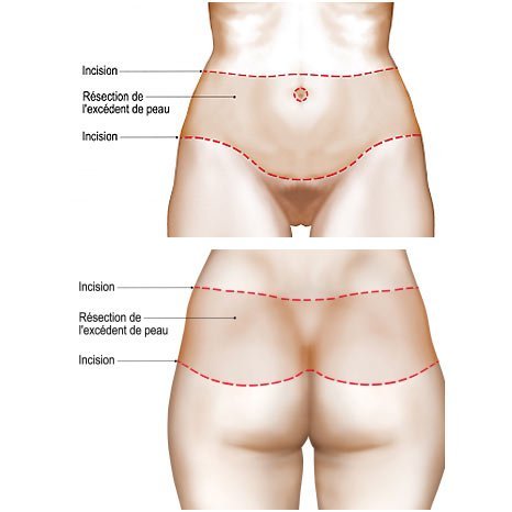 Cicatrices bodylift