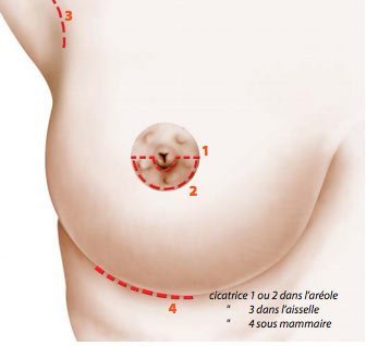 Cicatrices prothèses mammaires
