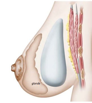 Prothèses mammaires déroulement de l'intervention