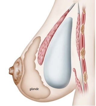 Prothèses mammaires déroulement de l'intervention