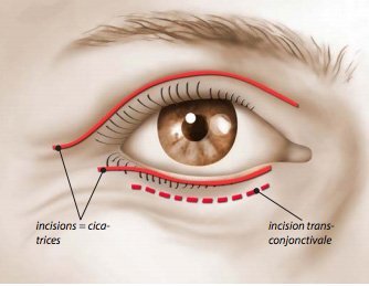 Blépharoplastie cicatrices