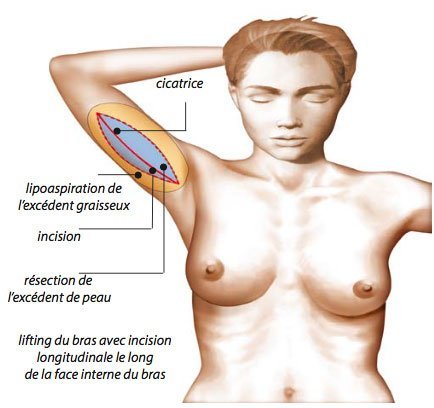 cicatrice brachioplastie