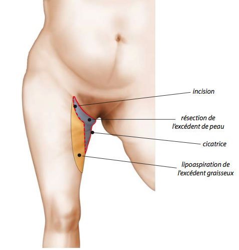 Cicatrice de lifting de cuisse