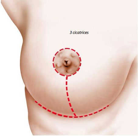 Cicatrices de mastopexie