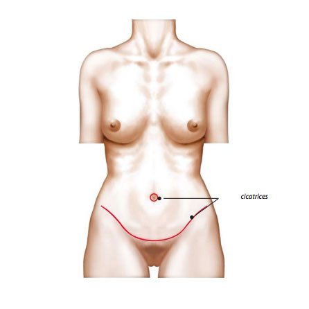 Plastie abdominale - Tarif et infos Abdominoplastie à Paris