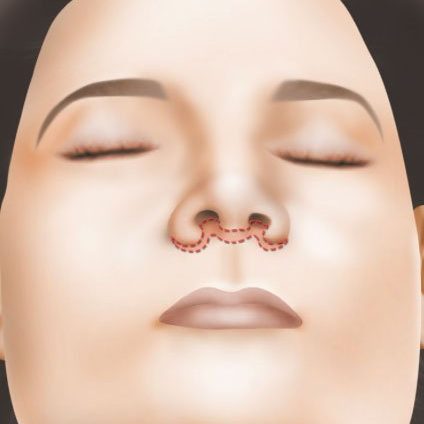 Liplift - lifting de lèvre supérieure