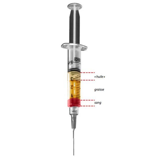 Lipofilling du visage