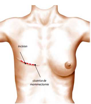 Reconstruction mammaire