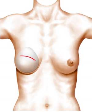 Reconstruction mammaire