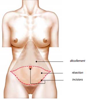 Reconstruction mammaire