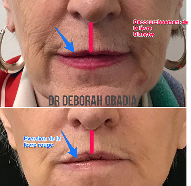 Liplift Dr Obadia