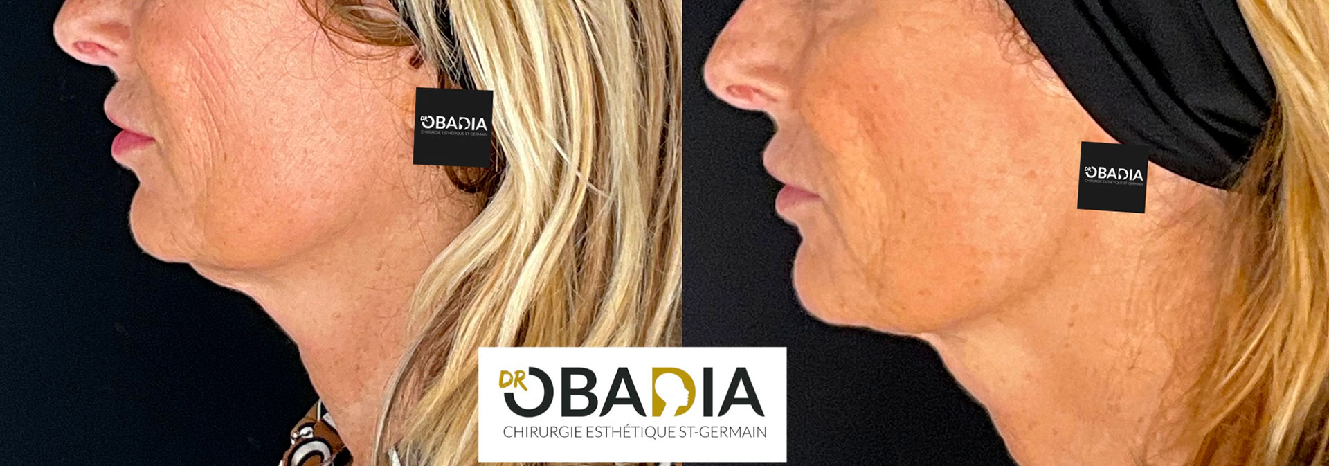 Skinbooster avant après