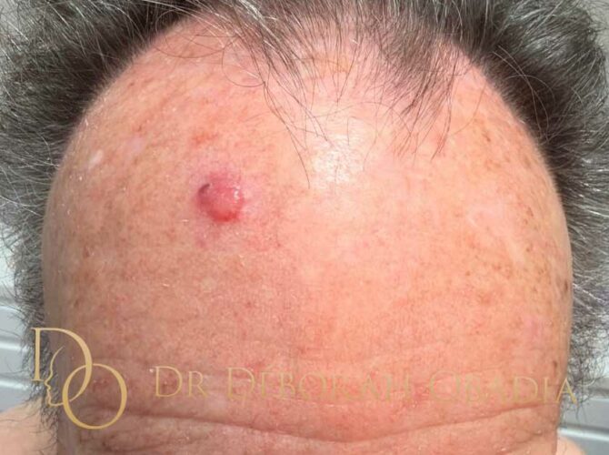 Cancer de la peau du visage pris en charge par chirurgie reconstructrice à Paris