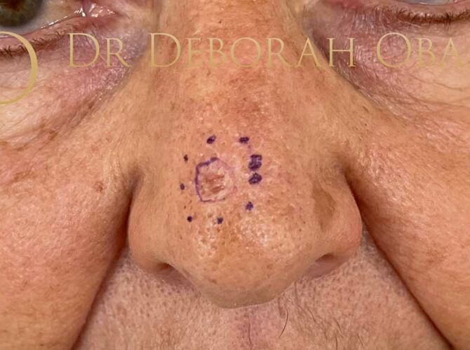 Carcinome basocellulaire du nez avant traitement chirurgical à Paris