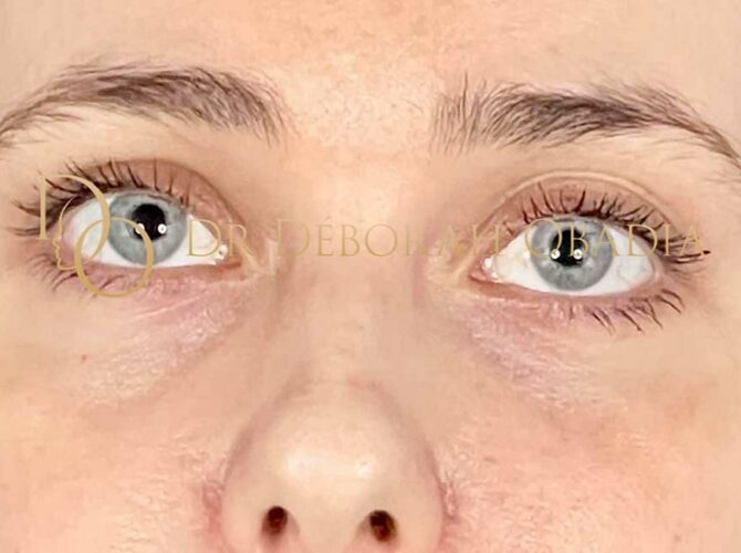 Résultat après lipofilling des cernes et blépharoplastie inférieure avec correction du volume et amélioration de la qualité de peau par nanofat.