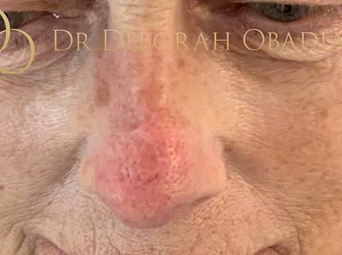 Résultat après reconstruction faciale suite à l’exérèse d’un cancer de la peau du visage
